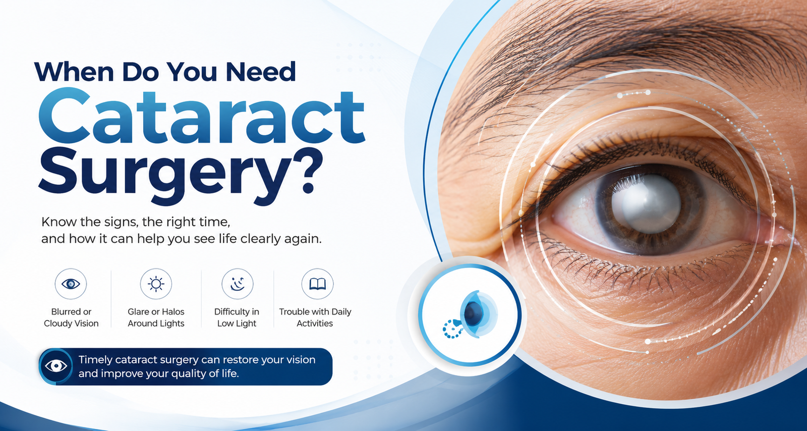When Do You Need Cataract Surgery?